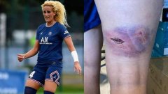 巴黎女球员受伤图曝光 传前巴萨高层妻子雇人殴